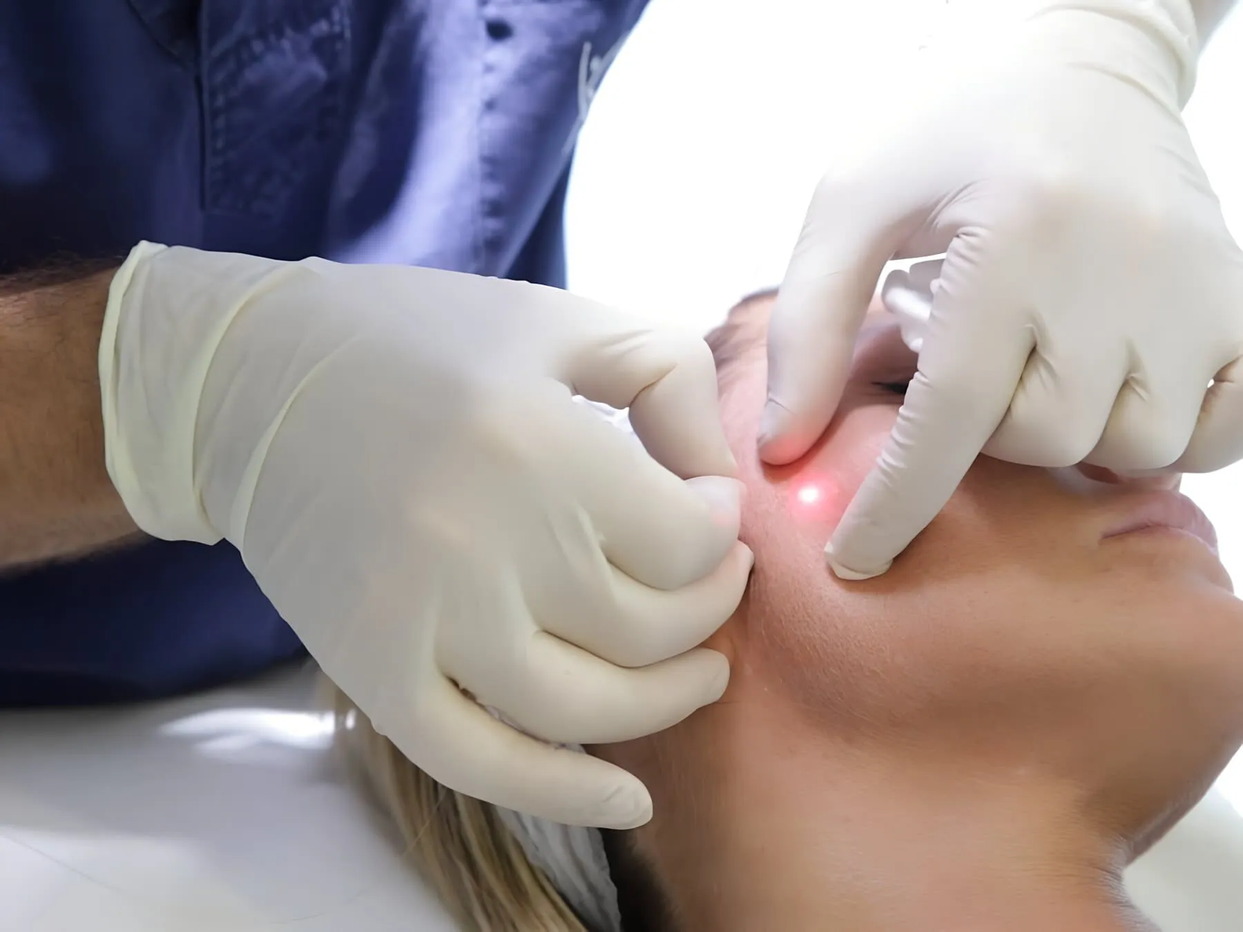 The EndoTight laser fiber used for non-surgical skin tightening