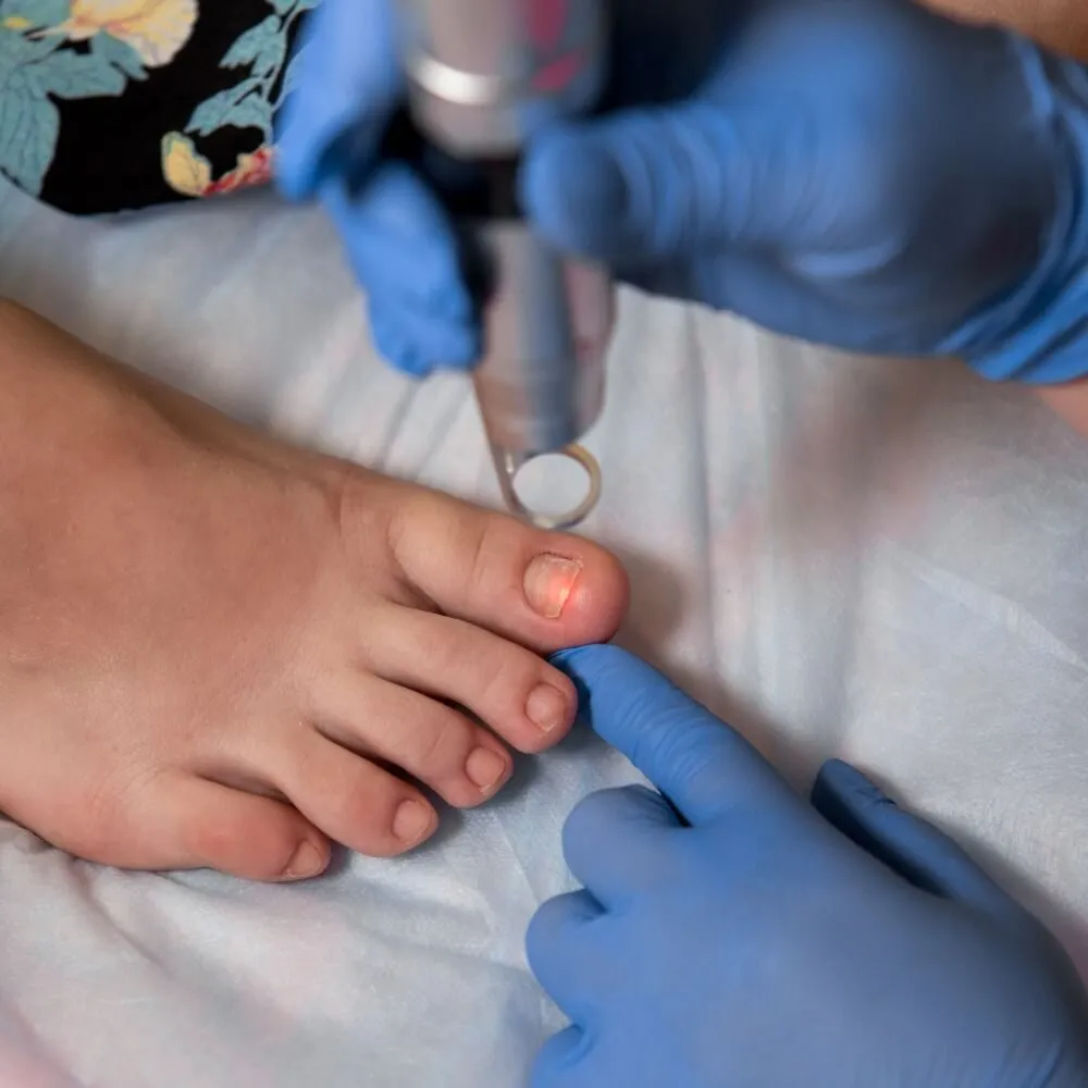 A slim Fotona laser handpiece held over an infected big toenail during a fungal nail treatment session, the foot steadied in gloved hands