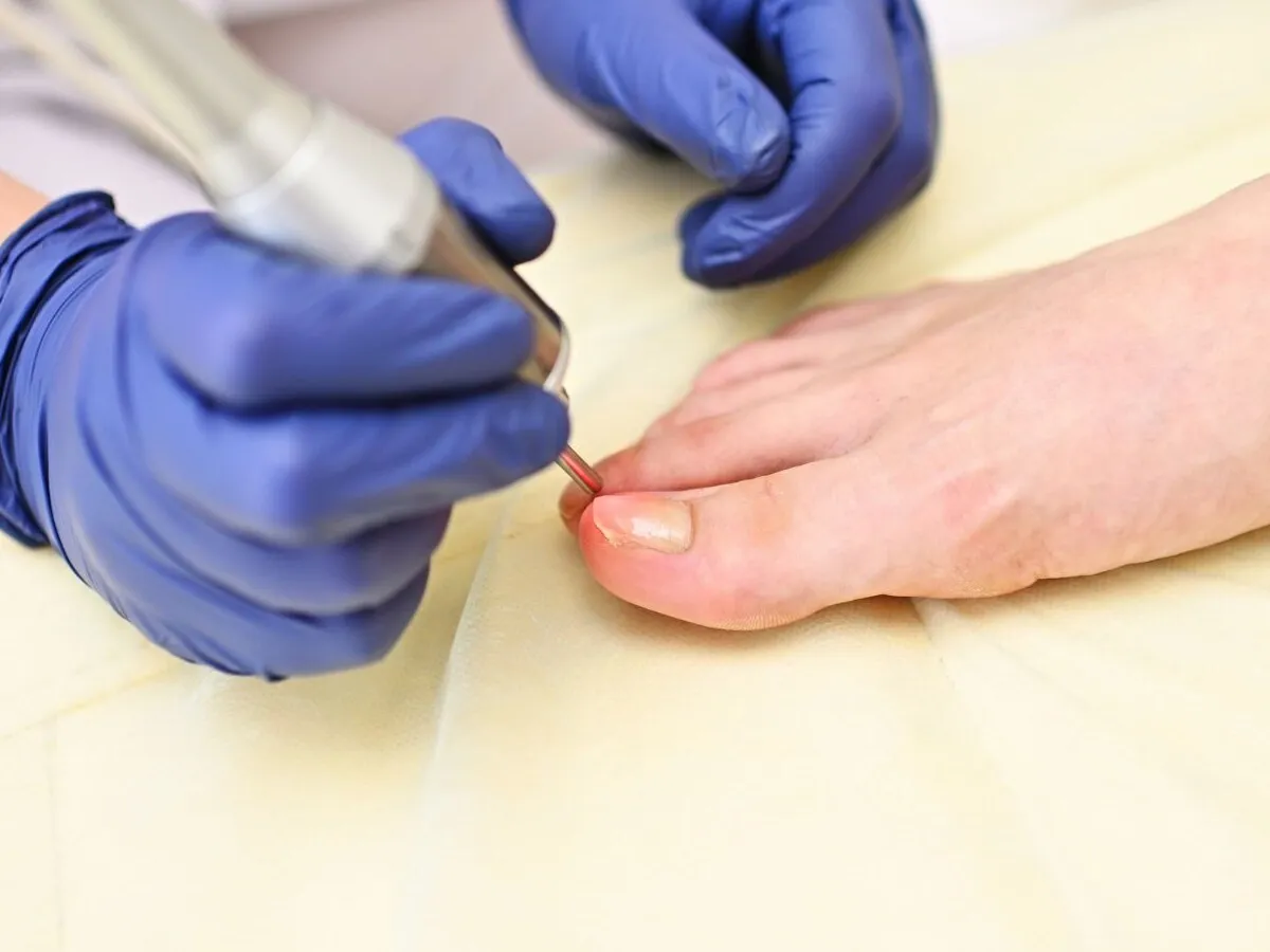 Fotona laser fungal nail treatment on the toenails at Medrein Health