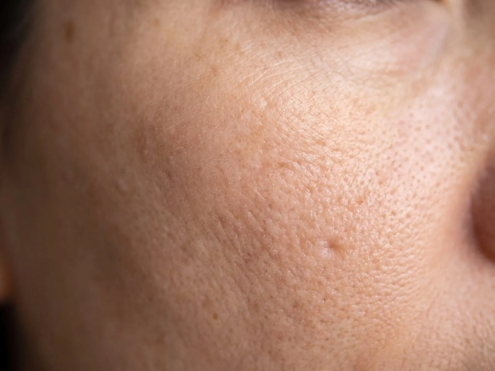 Macro close-up of cheek skin showing enlarged pores, fine lines and uneven pigment, the surface an Erbium resurfacing pass renews