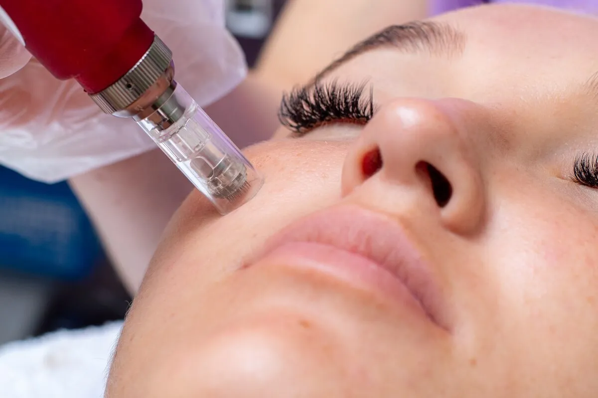 A microneedling pen with a visible needle cartridge held against the cheek of a reclining patient during a SkinPen session