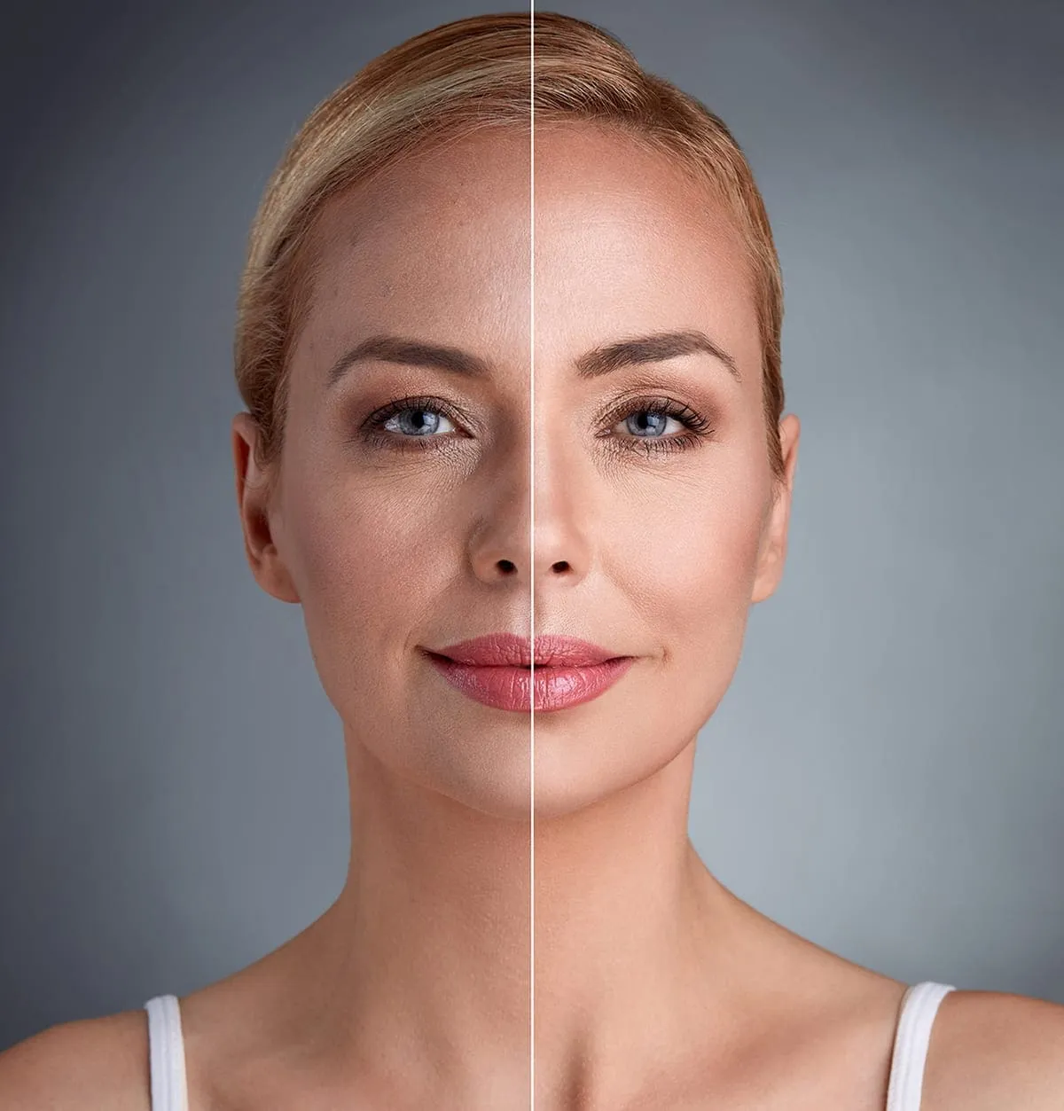 a female who had endolift procedure