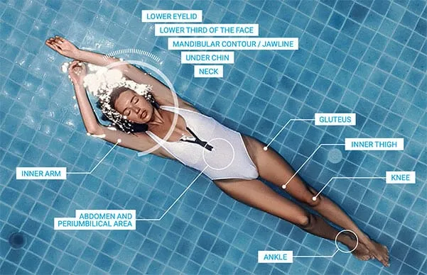 endolift treatment areas