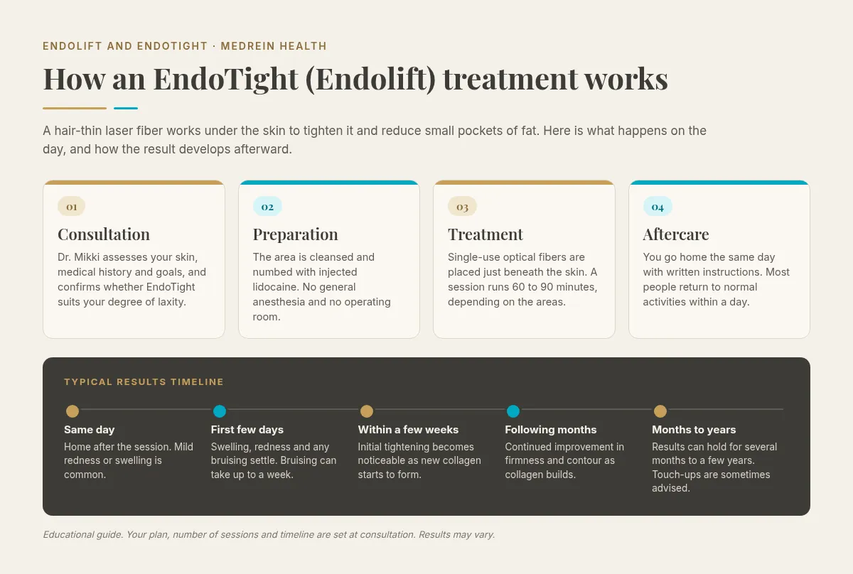 Infographic of how an EndoTight (Endolift) treatment works in four steps: consultation with Dr. Mikki, preparation with injected lidocaine, treatment with single-use optical fibers in a 60 to 90 minute session, and same-day aftercare, above a results timeline from same day to first few days, a few weeks, the following months, and results holding for months to years.