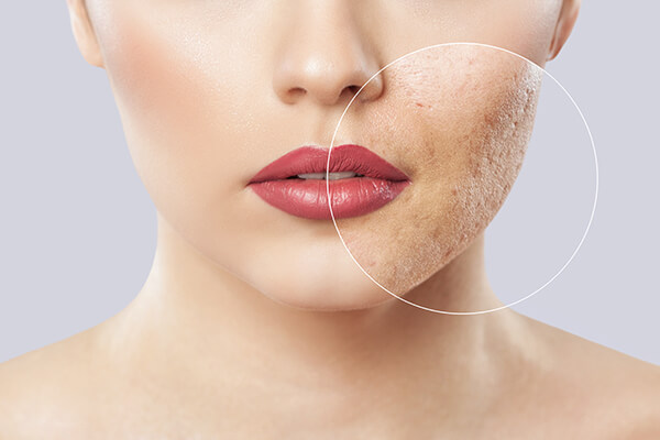 Restore Your Face by Removing Acne Scars with Our Minimally Invasive Procedures