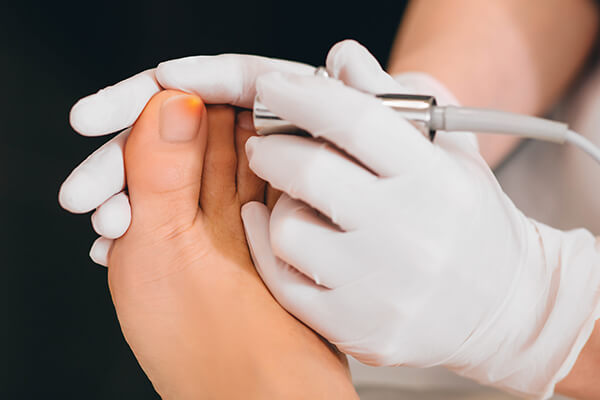 Get Rid of Discolored and Smelly Nails with Our State-Of-The-Art Fungal Nail Treatments