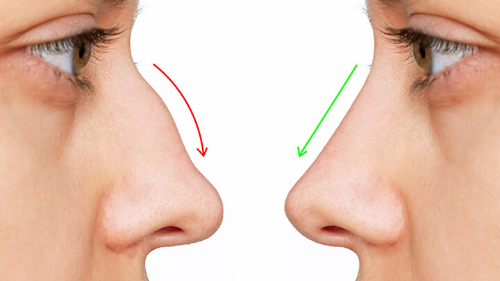 Effortlessly Reshape Your Nose for a Complimenting Overall Look with Our Non-Surgical Rhinoplasty