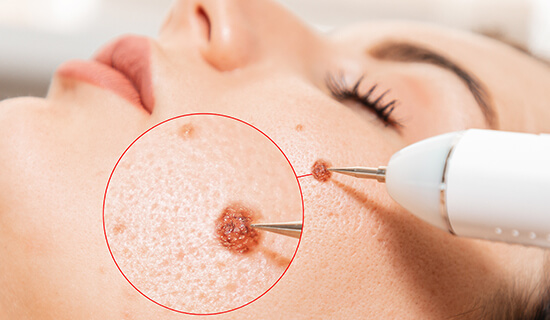 Skin Tag & Wart Removal