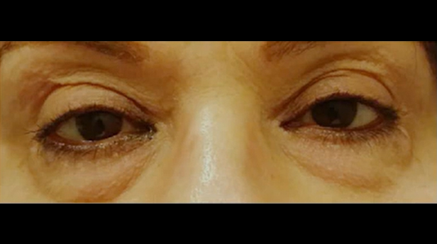 Under Eye Bags/Tired Eyes - Steele Dermatology Atlanta Alpharetta Georgia