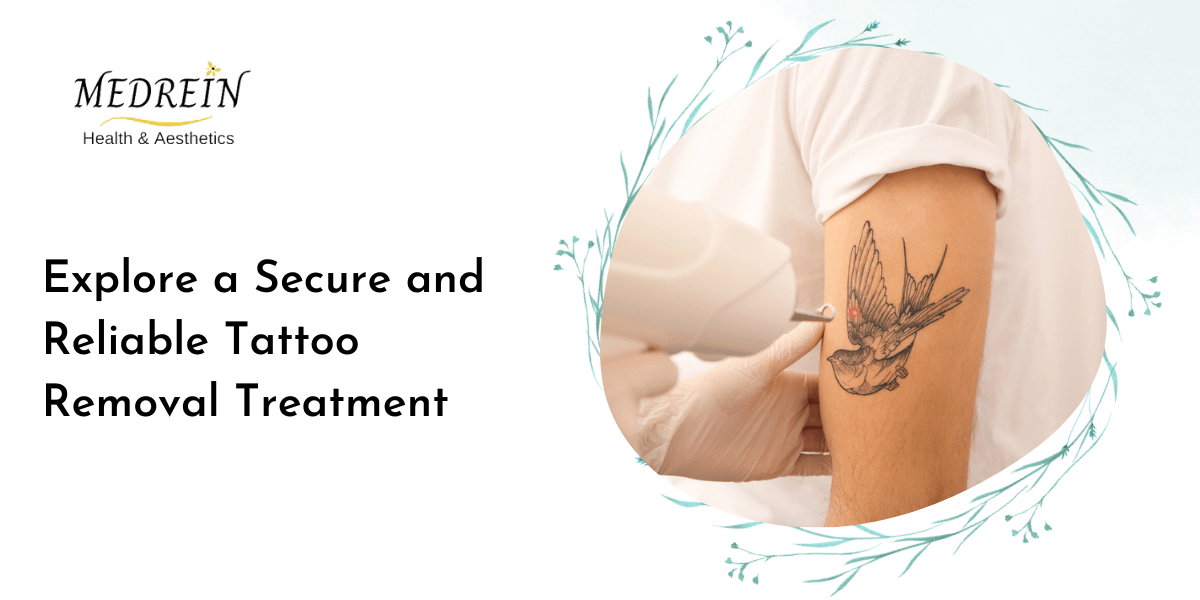 Explore a Secure and Reliable Tattoo Removal Treatment