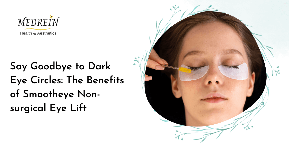 Say Goodbye to Dark Eye Circles The Benefits of Smootheye Non-surgical Eye Lift