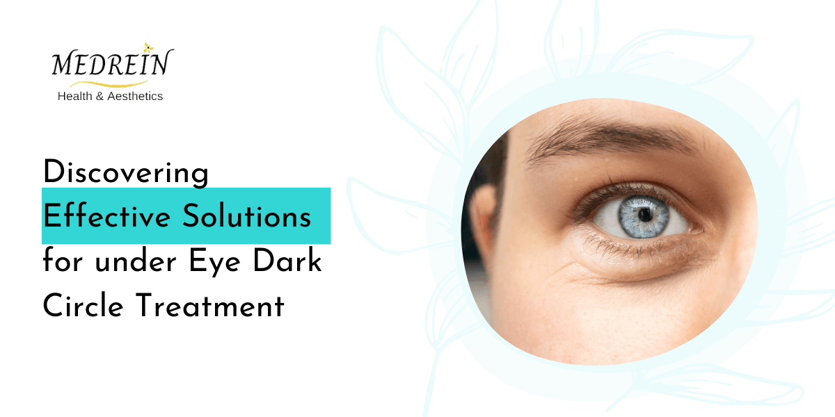 Discovering Effective Solutions for under Eye Dark Circle Treatment