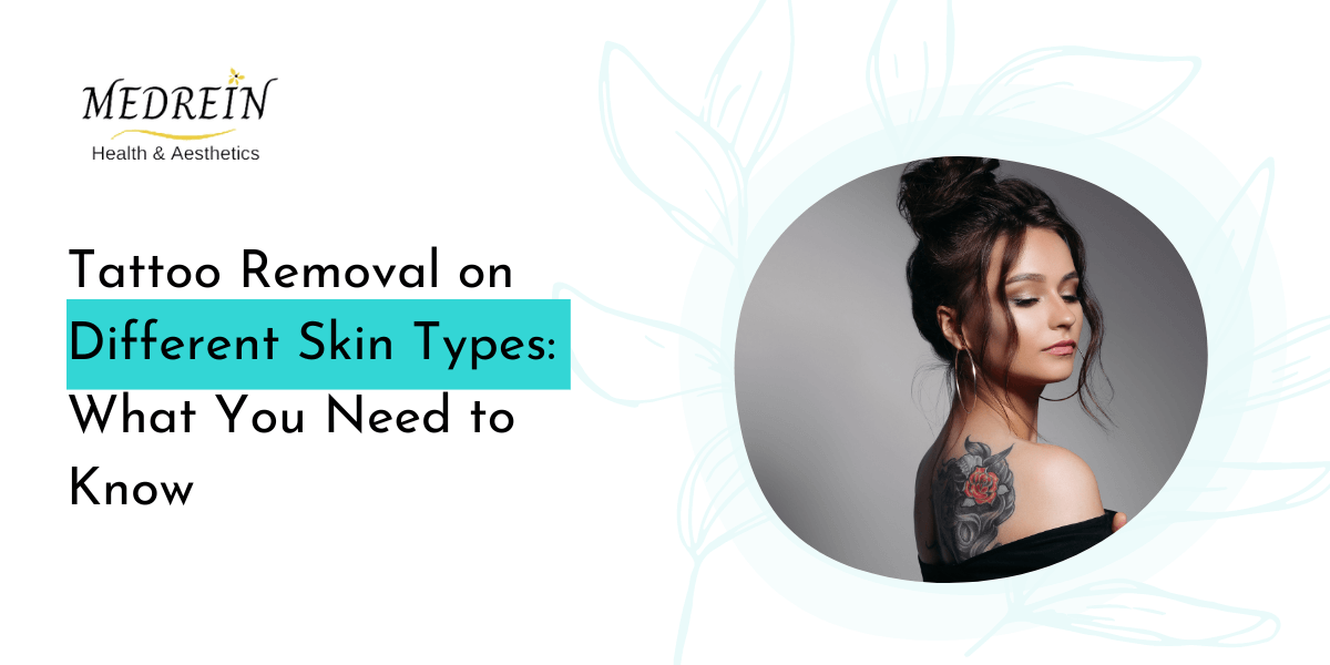 Tattoo Removal on Different Skin Types What You Need to Know