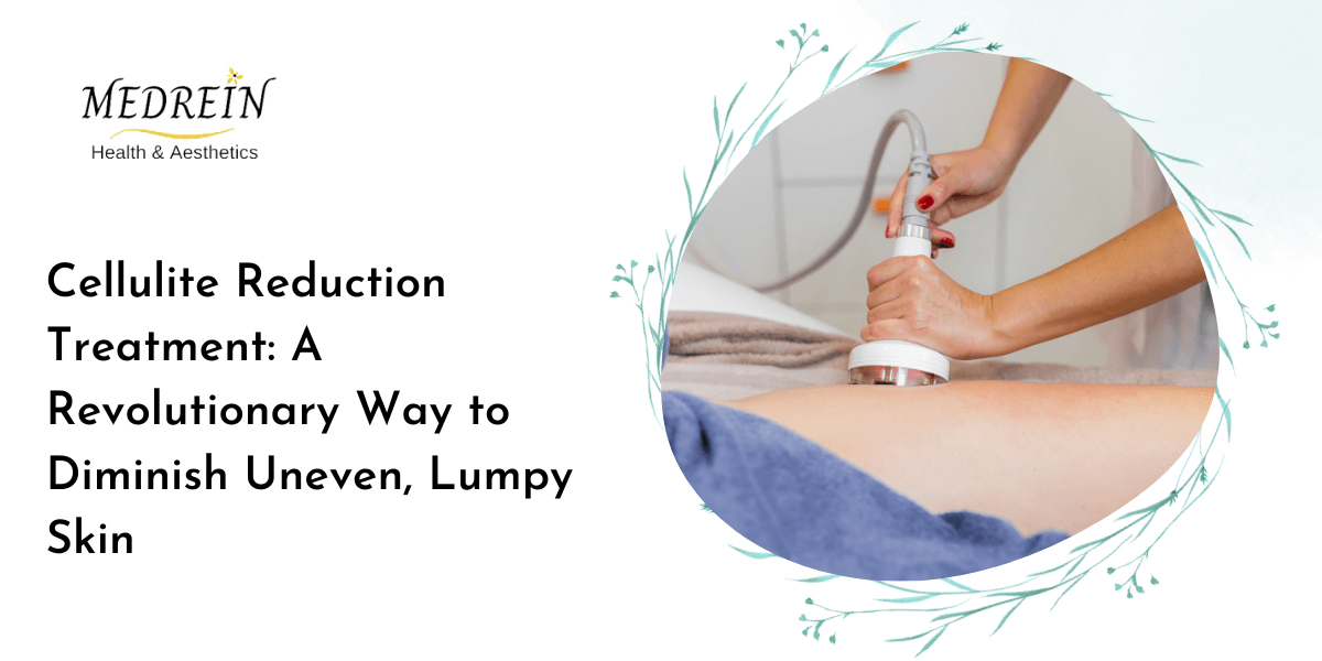Cellulite Reduction Treatment: A Revolutionary Way to Diminish Uneven, Lumpy Skin