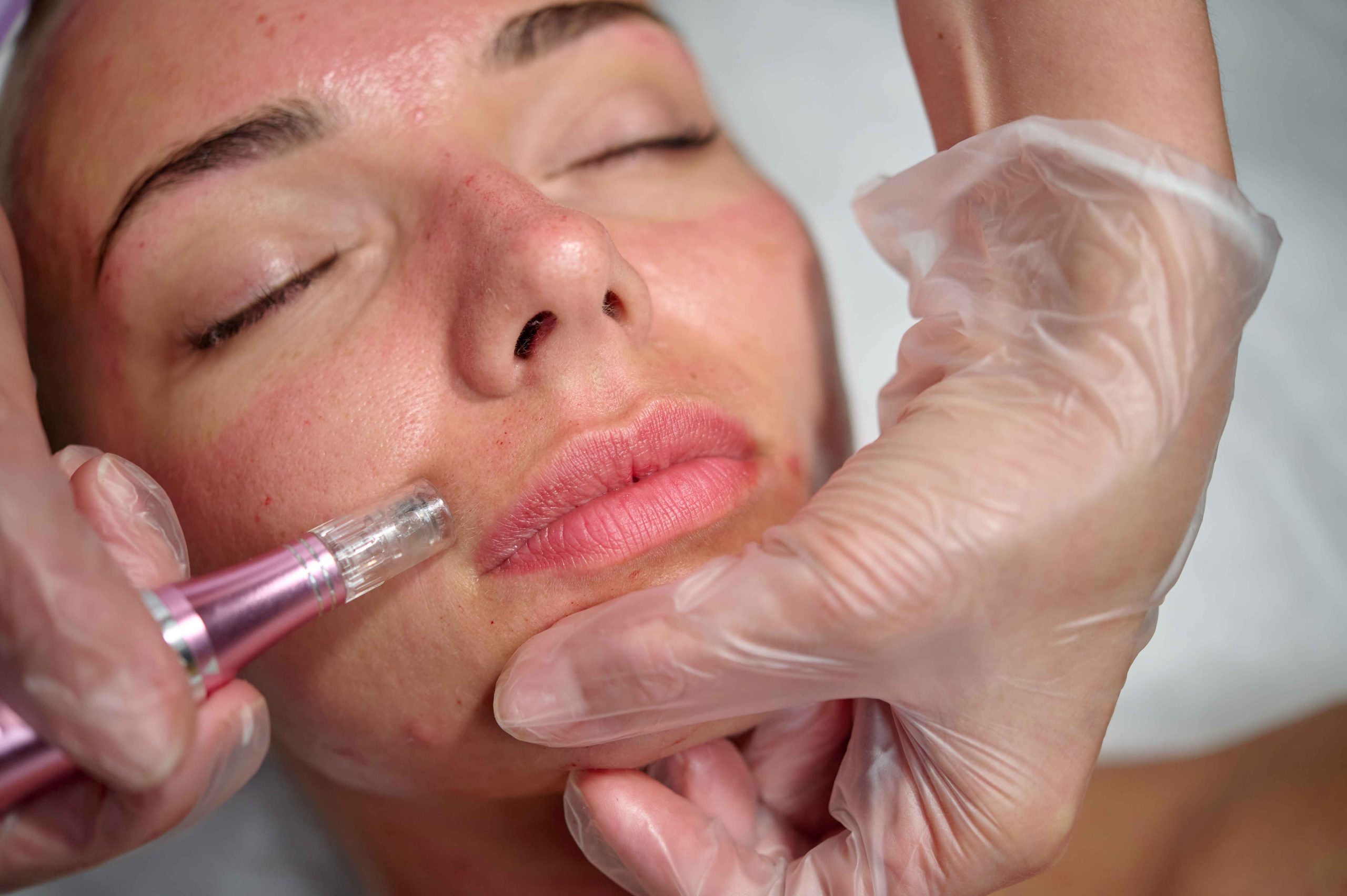 Dermaplaning Treatment for Smoother, Softer Skin
