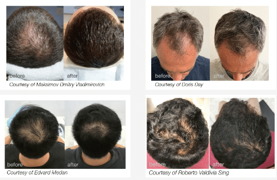 HaiRestart – Advanced Laser Hair Restoration