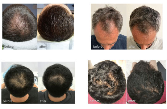 Get Rid of Thinning Hair and Bald Spots with Our Superior PRP / PRF Hair Restoration Services